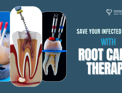 Root Canal in Plantation, FL