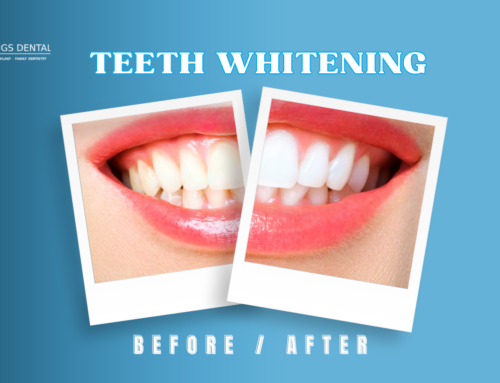 Teeth Whitening in Plantation, FL