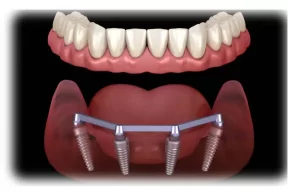 A graphic image of All-on-Four denture lowers.
