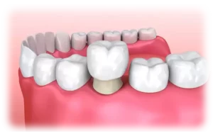 A graphical depiction of a dental crown being placed over a prepared tooth in Plantation, FL