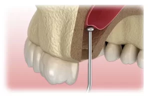 A graphic image of the sinus lift process.