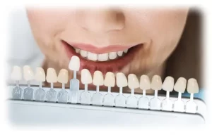 A woman with a shade guide for porcelain veneers.