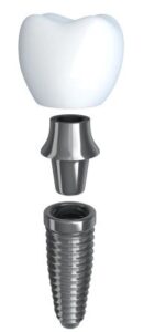 A graphic image of the anatomy of a dental implant.