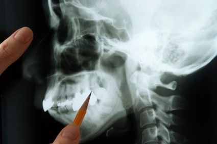 A dentist pointing to an image of a jawbone.