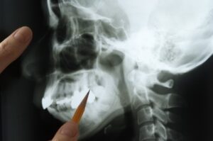 A jawbone being examined for signs of night grinding.